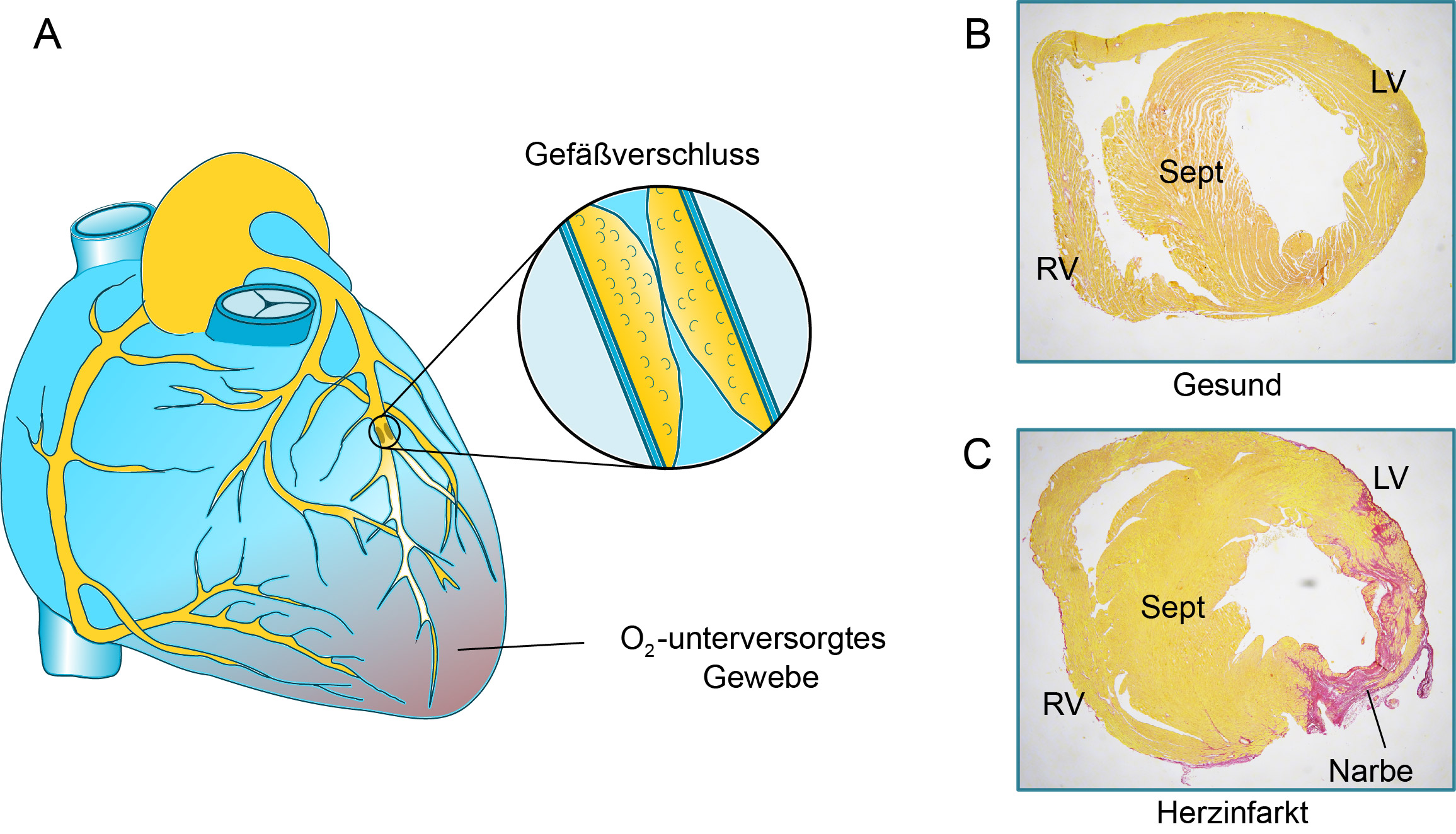 (A) Ist eine Herzkranzarterie verschlossen, wird das darunterliegende Herzmuskelgewebe nicht mehr mit Blut und Sauerstoff (O2) versorgt. (B) Gesundes, ausreichend perfundiertes Herzmuskelgewebe ist im histologischen Präparat gelb gefärbt. (C) Die minderperfundierten Herzmuskelzellen gehen nach einiger Zeit unter und werden durch eine kollagenhaltige Narbe ersetzt (rot), die den linken Ventrikel vor dem Aufplatzen schützt, jedoch nicht zur Herzaktion beiträgt. RV – rechter Ventrikel, Sept – Septum, LV – linker Ventrikel. Mit freundlicher Genehmigung des Instituts für Kardiovaskuläre Regeneration der Goethe-Universität Frankfurt am Main 